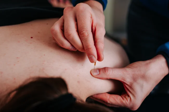 Dry Needling Eindhoven