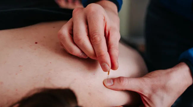 Dry Needling