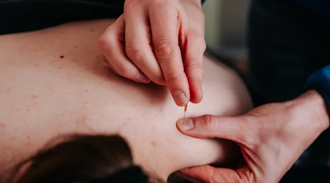 Dry Needling