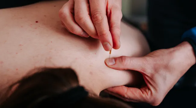 Dry Needling