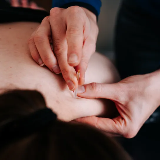 Dry Needling